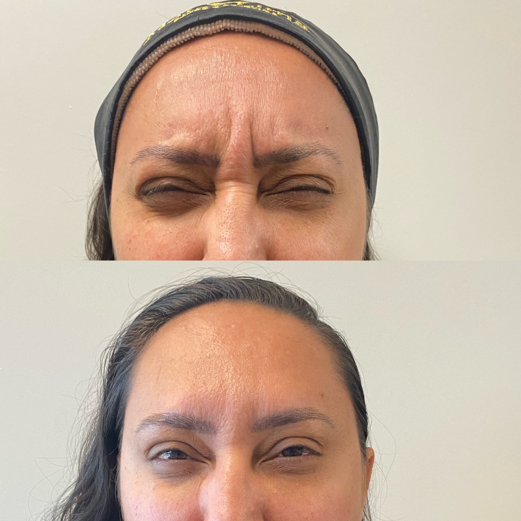 Resultado Toxina botulínica-Botox 1