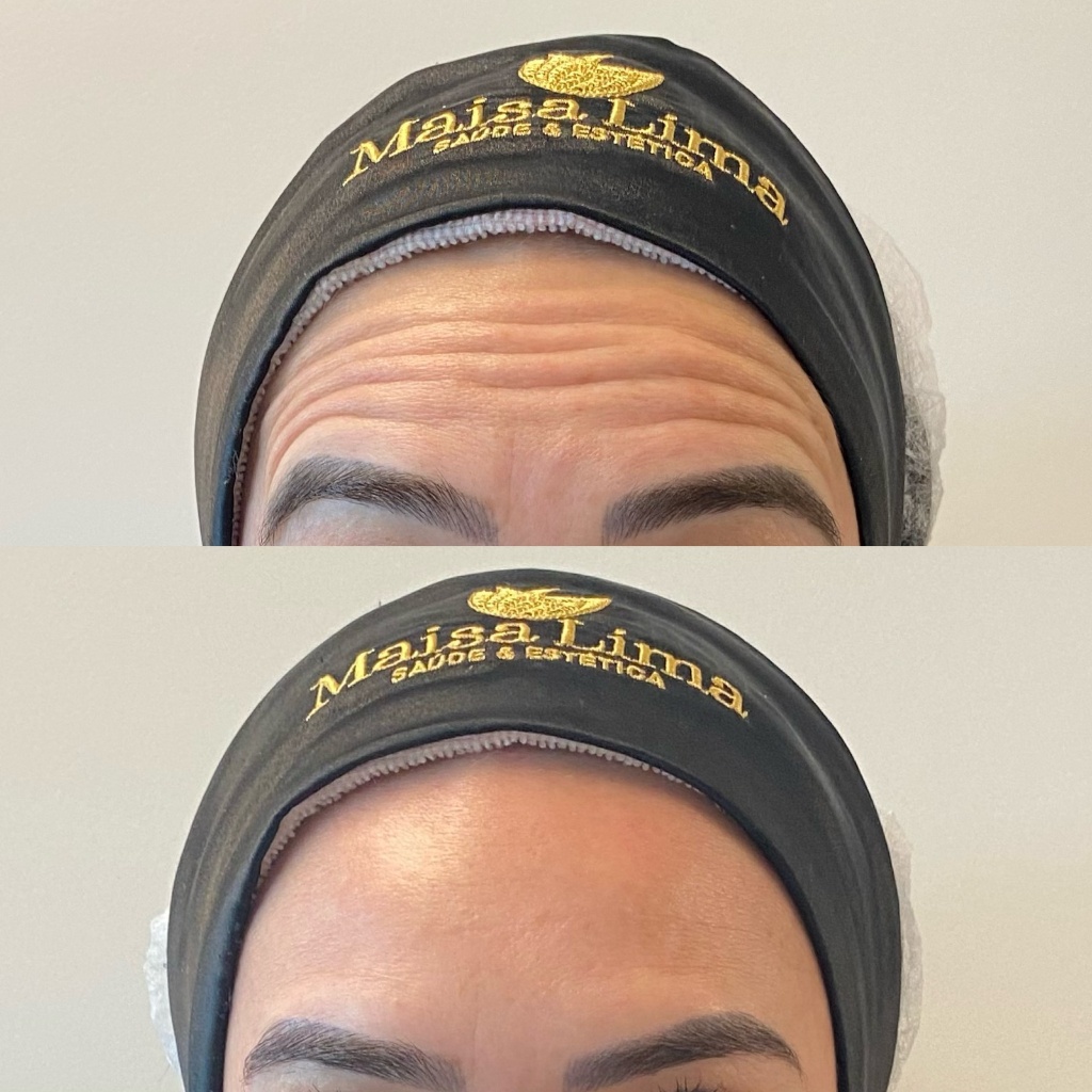 Resultado Toxina botulínica-Botox 2