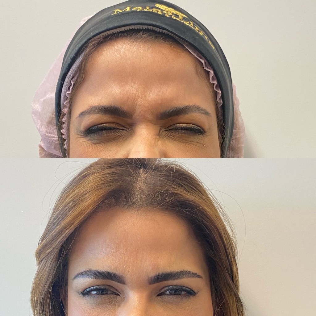 Resultado Toxina botulínica-Botox 3