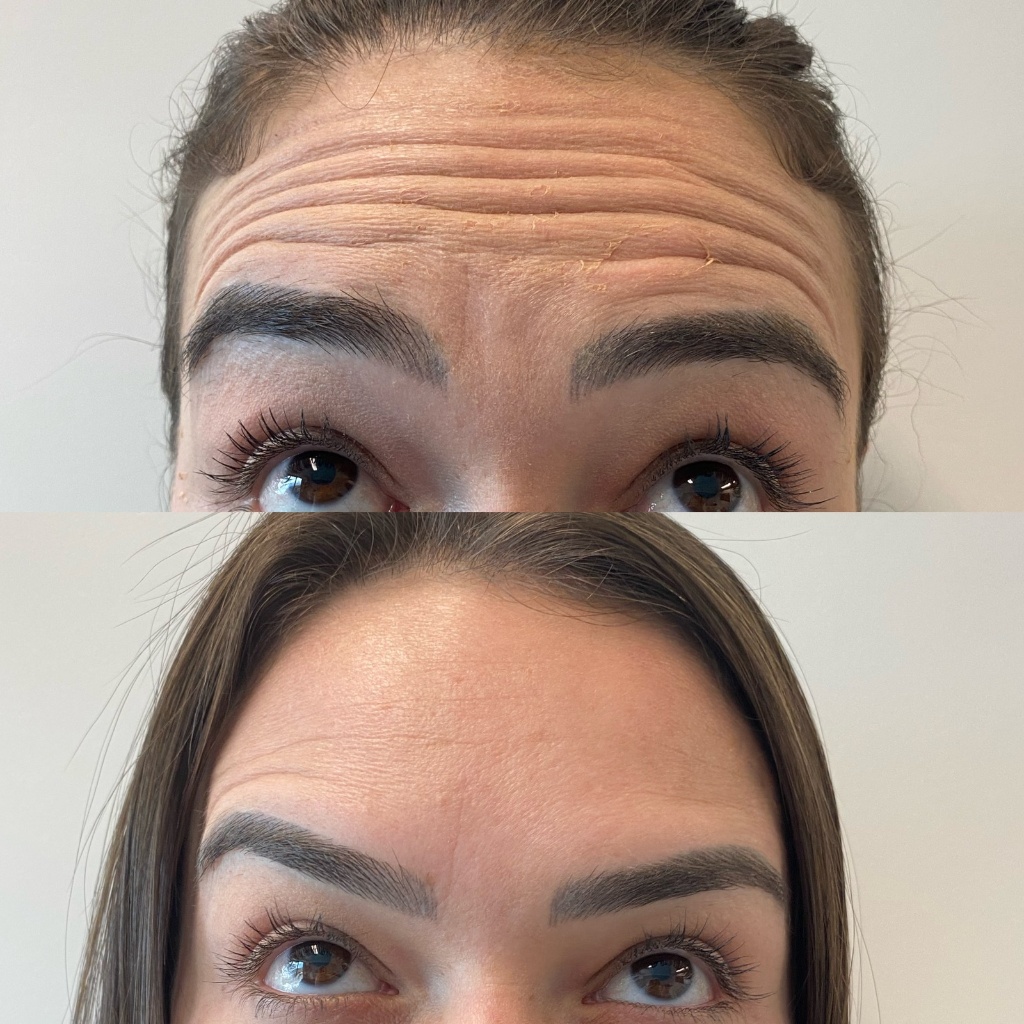 Resultado Toxina botulínica-Botox 4