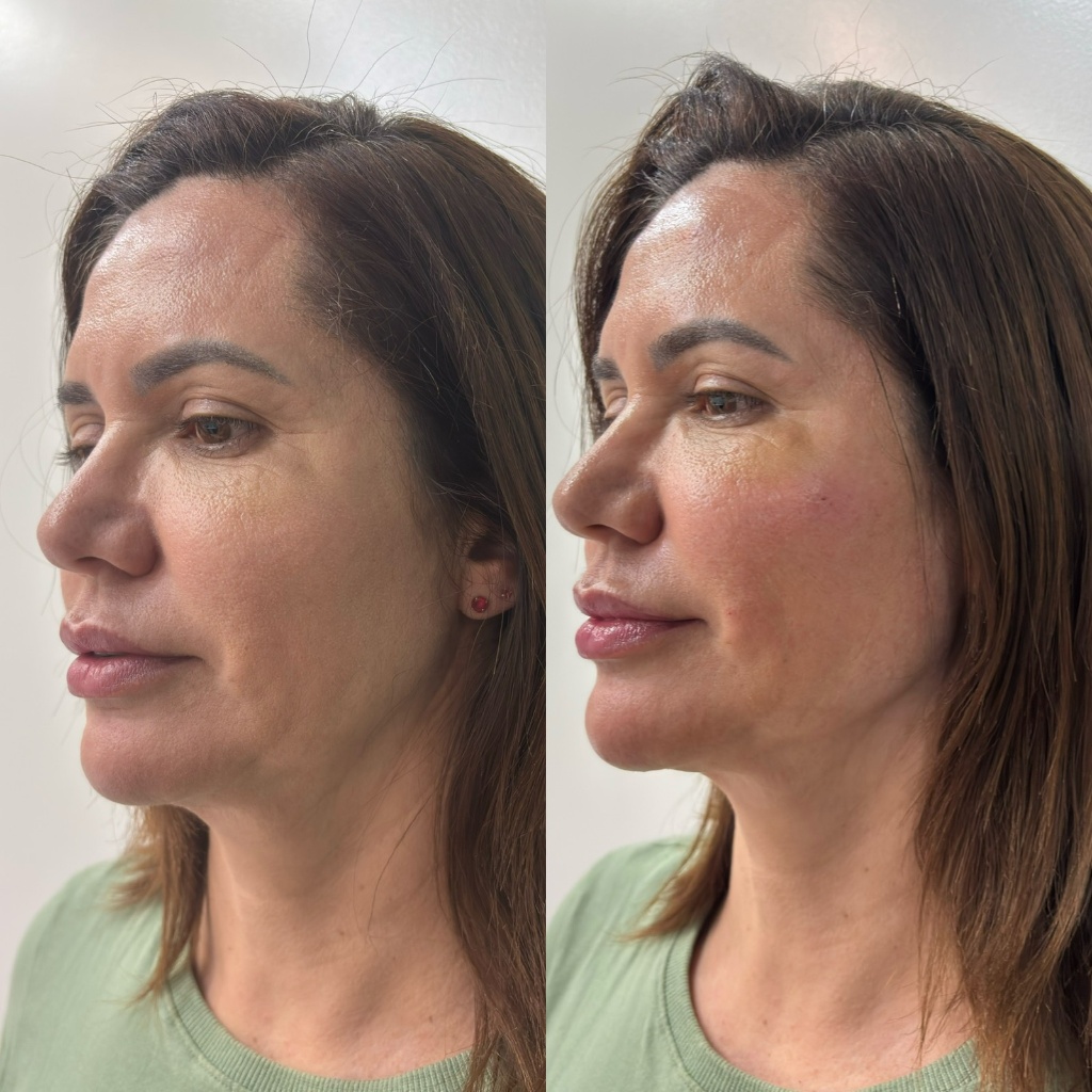 Resultado Harmonização Facial 1