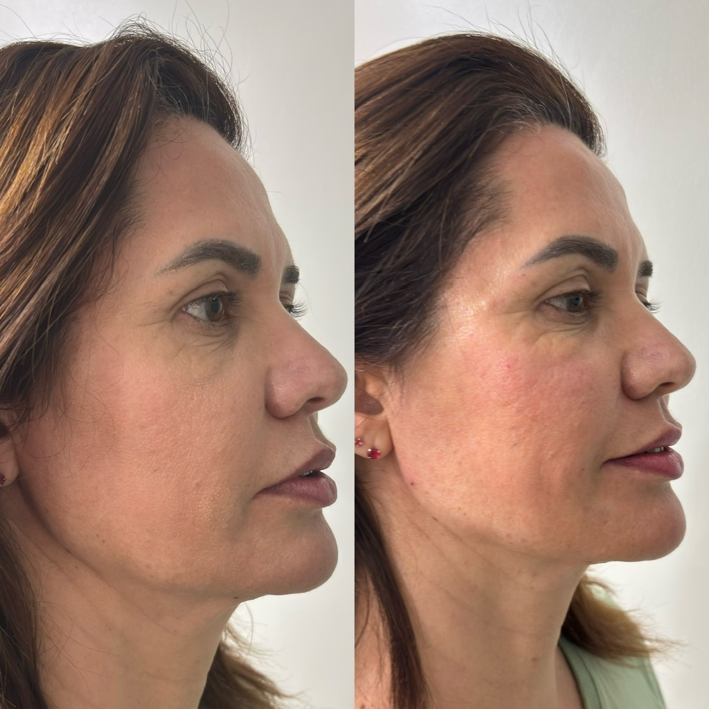 Resultado Harmonização Facial 2