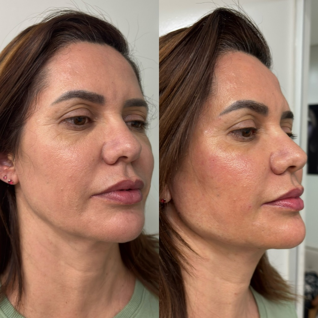 Harmonização Facial