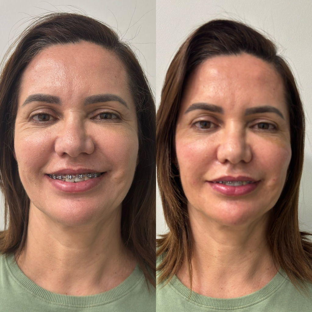 Resultado Harmonização Facial 4