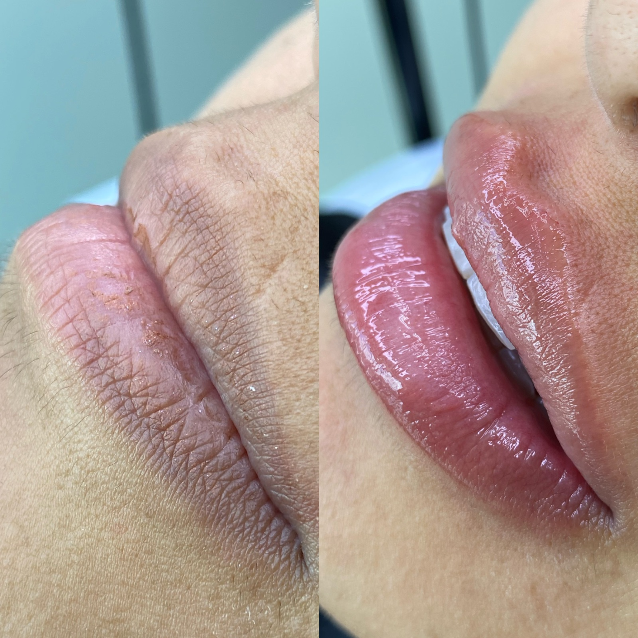 Preenchimento Labial