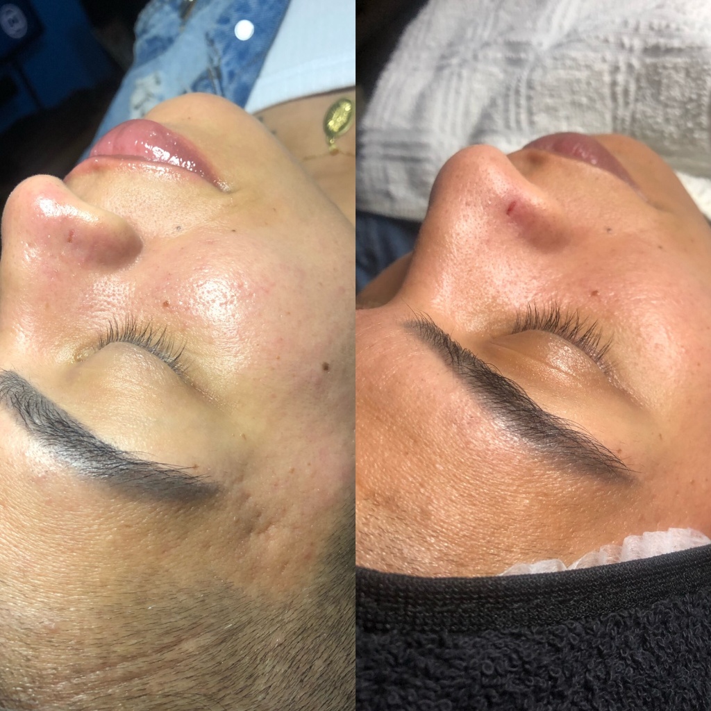 Limpeza de pele profunda