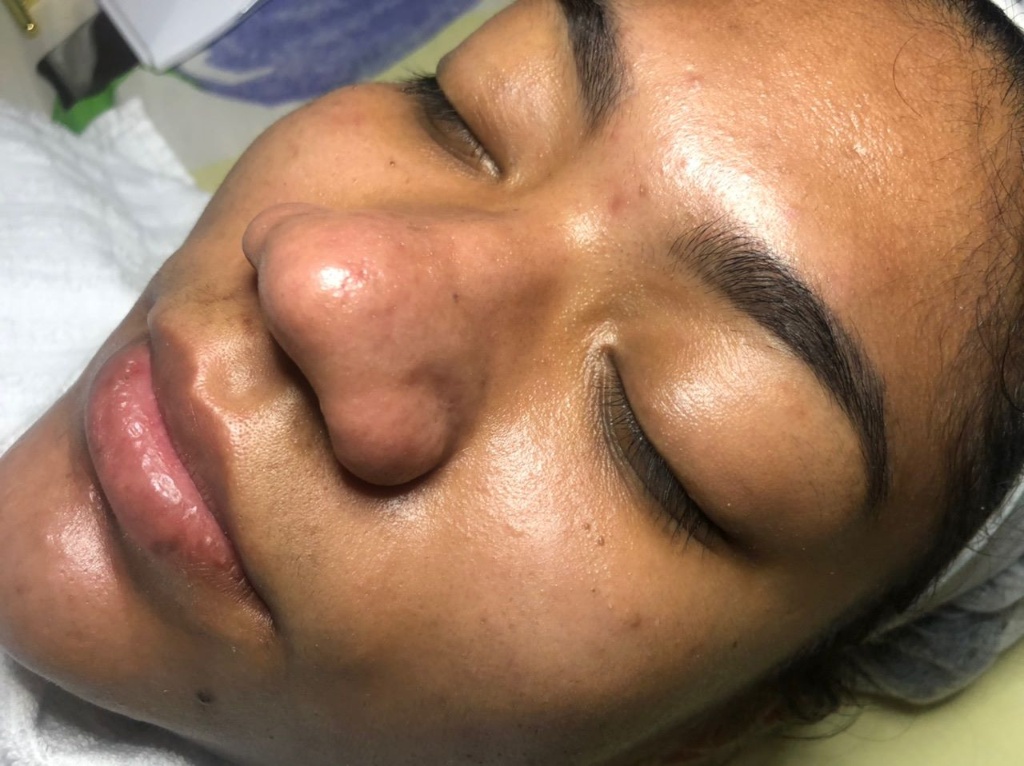 Resultado Limpeza de pele profunda 1