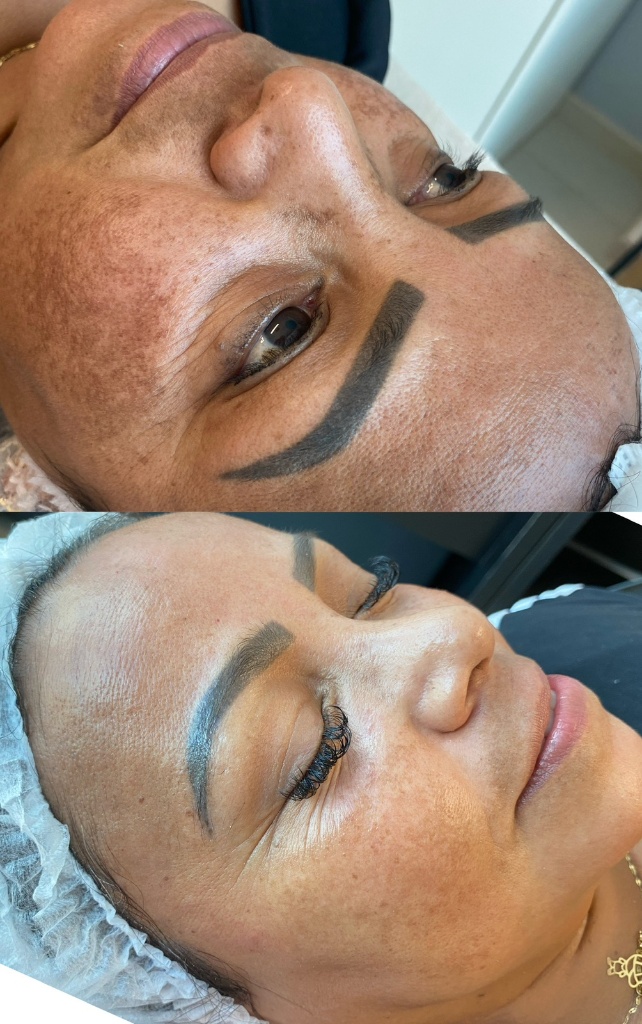 Resultado Peeling Químico (Melasma) 1