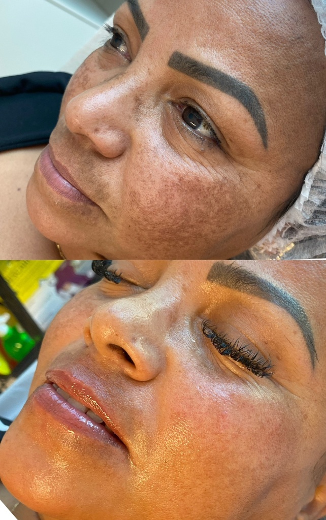 Peeling Químico (Melasma)