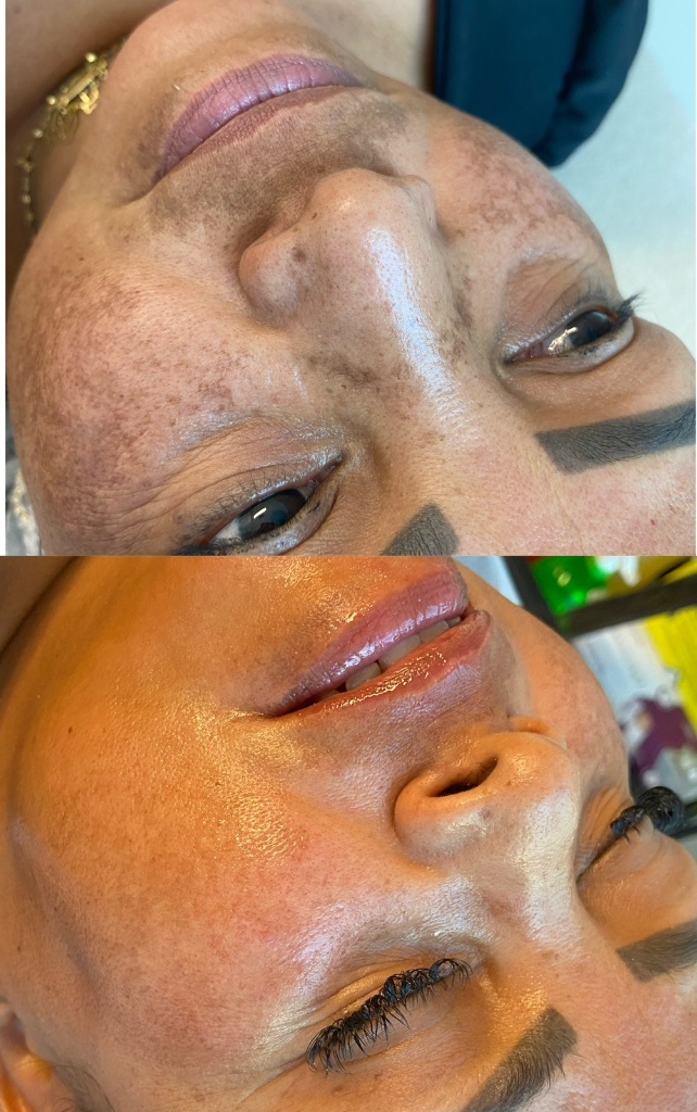 Resultado Peeling Químico (Melasma) 3